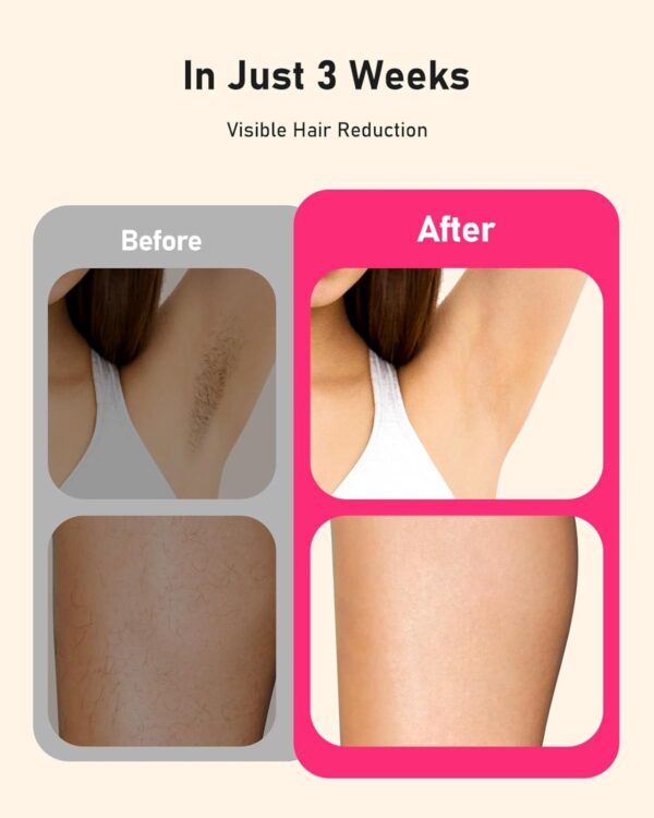 Limited time deal-55% LYSMOSKI Laser Hair Removal for Women and Men, Long-Lasting - Image 4